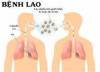 Bệnh lao ở Việt Nam